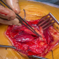 The Different Types of Excisional Surgery and What You Need to Know
