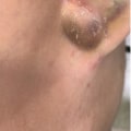 Cryosurgery: A Comprehensive Overview