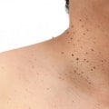 Applying Over-the-Counter Creams to Skin Tags