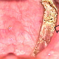 Electrocautery: A Comprehensive Overview