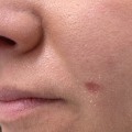 Pros and Cons of Laser Mole Removal Technique