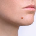 Aftercare for Surgical Mole Removal