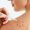 Chemical Treatments for Skin Tag Removal