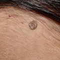 Keeping Your Area Clean and Dry: A Comprehensive Guide to Mole Removal Aftercare