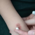Burns and Blisters: The Risks of Home Mole Removal Treatments
