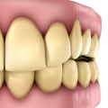 Discoloration Risks: A Comprehensive Overview