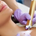 Medicaid Coverage for Mole Removal