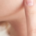 Affordable Mole Removal: Discounts and Payment Plans Explained
