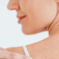 Cryosurgery: Exploring Mole Removal Procedures