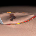 Overview of the Excisional Biopsy Technique