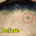 Apple Cider Vinegar for Mole Removal: A Natural Treatment