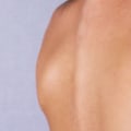 All About the Cost of Freezing Mole Removal