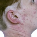 Allergic Reactions Risks: What You Need to Know