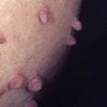 Removing Skin Tags with Apple Cider Vinegar