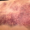 Reducing Swelling and Bruising After Mole Removal Surgery