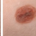 Recovery from Mole Removal Surgery