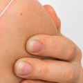 Freezing Mole Removal Aftercare: A Comprehensive Guide