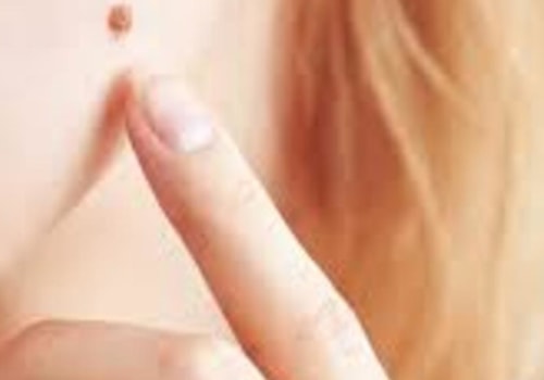 Onion Juice Remedy: A Natural Way to Remove Moles at Home