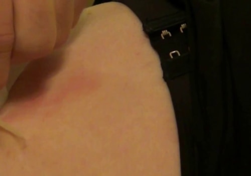 Tying Off a Skin Tag With a Thread or String