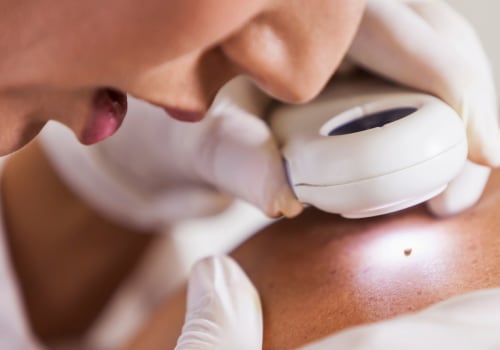Ligation and Excision: A Guide to Skin Tag Removal
