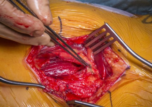 The Different Types of Excisional Surgery and What You Need to Know