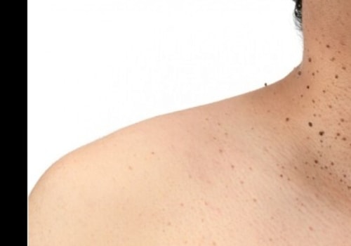 Applying Over-the-Counter Creams to Skin Tags