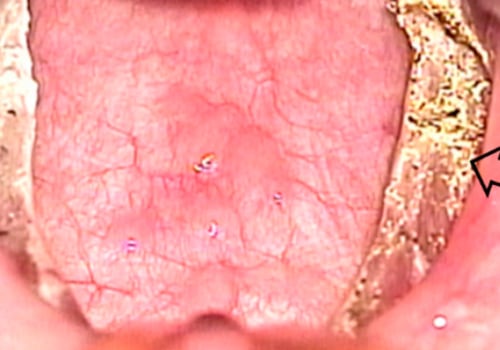 Electrocautery: A Comprehensive Overview