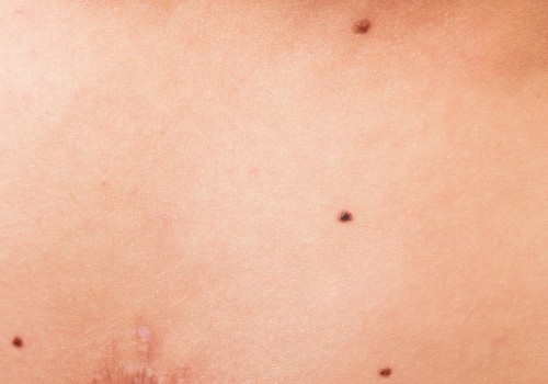 Aftercare Tips for Mole Removal Procedures: Avoiding Trauma to the Area