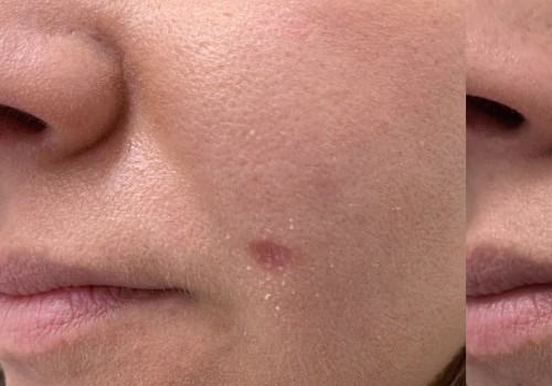 Pros and Cons of Laser Mole Removal Technique