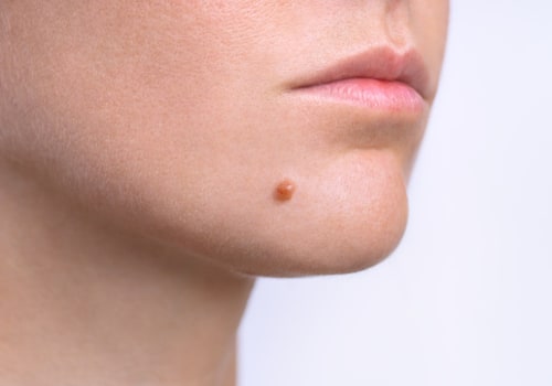 Aftercare for Surgical Mole Removal