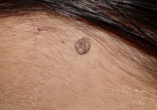 Keeping Your Area Clean and Dry: A Comprehensive Guide to Mole Removal Aftercare