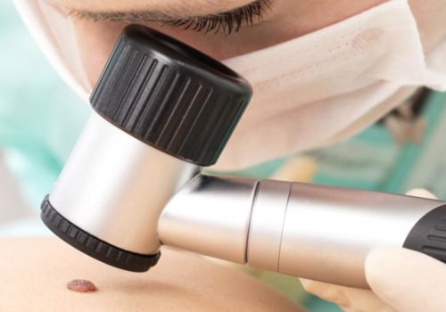 Natural Remedies for Mole Removal Procedures