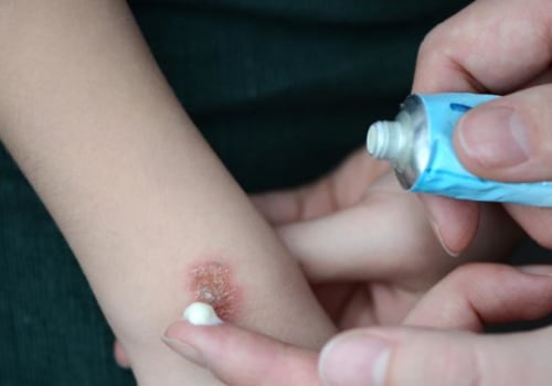 Burns and Blisters: The Risks of Home Mole Removal Treatments