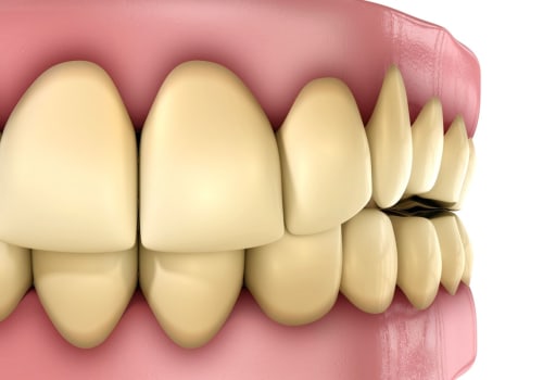 Discoloration Risks: A Comprehensive Overview