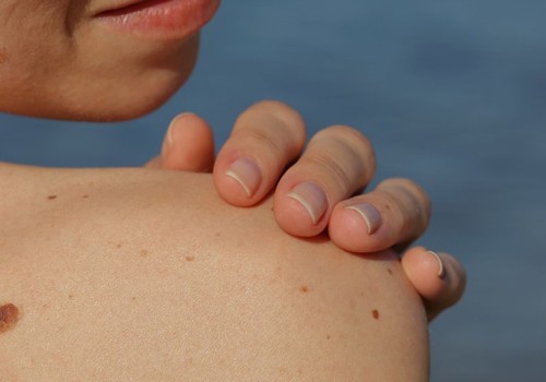 Aftercare for Freezing Mole Removal