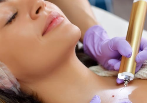 Medicaid Coverage for Mole Removal