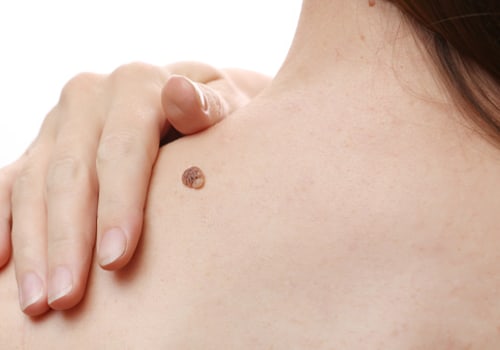 Managing Pain and Discomfort After Mole Removal Surgery