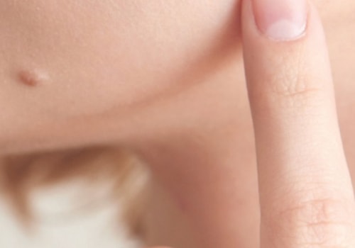 Affordable Mole Removal: Discounts and Payment Plans Explained
