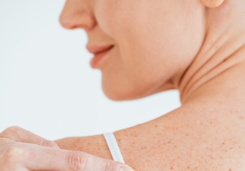 Cryosurgery: Exploring Mole Removal Procedures