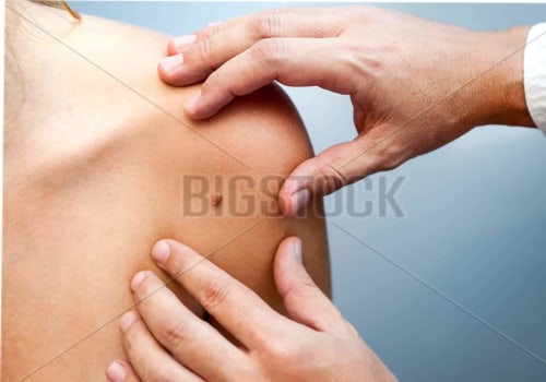 Scheduling the Procedure for Mole Removal Surgery