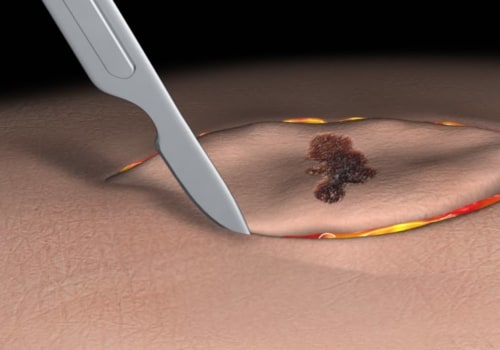 Overview of the Excisional Biopsy Technique