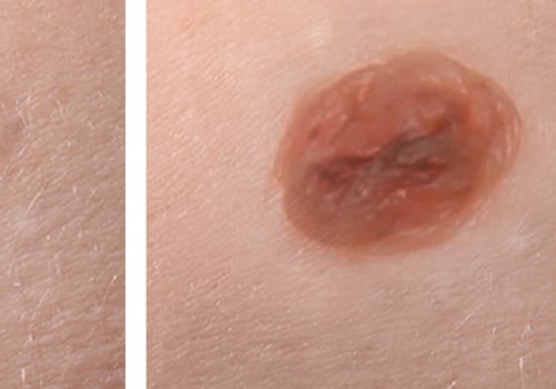 Reduced Risk of Infection After Mole Removal Surgery