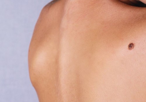 All About the Cost of Freezing Mole Removal