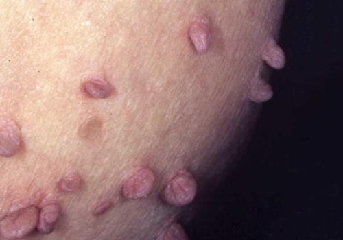 Using Tea Tree Oil to Remove Skin Tags