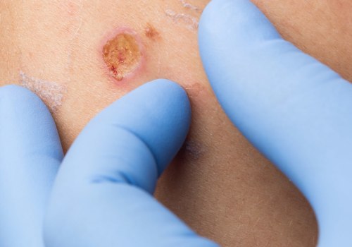 The Risks of Damage to Surrounding Tissue During Mole Removal