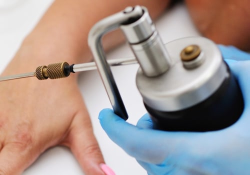 Types of Freezing Mole Removal