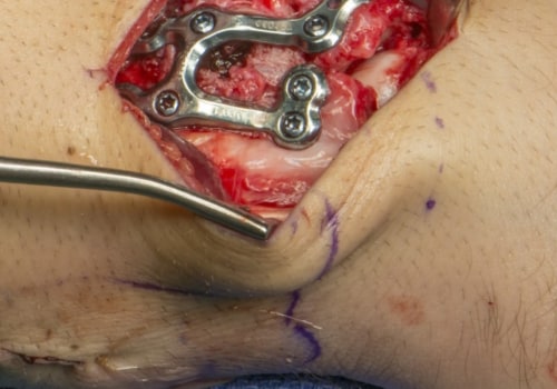 A Comprehensive Look at Surgical Excision