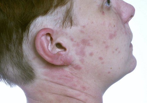 Allergic Reactions Risks: What You Need to Know
