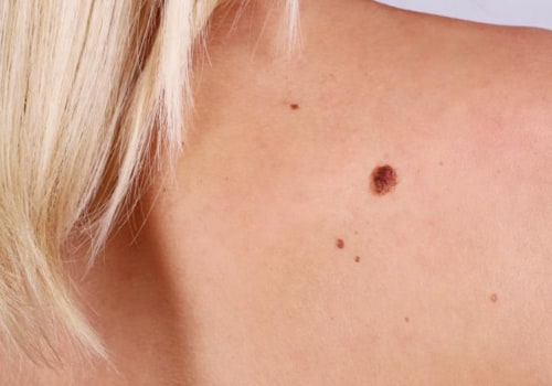 Using Baking Soda for Mole Removal