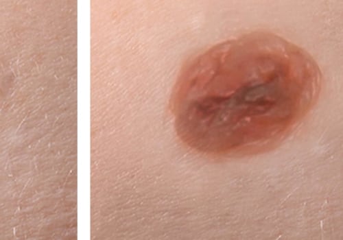 Aftercare for Laser Mole Removal